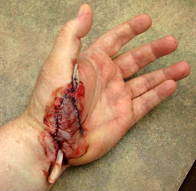 power drill accidents