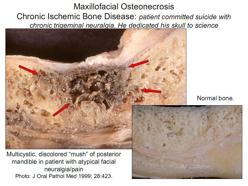 http://i126.photobucket.com/albums/p95/dukeeeey/dental%20stuff/bonedisease.jpg