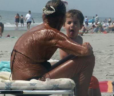 Bilderesultat for worst sunburn